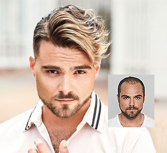 mens hair replacement pittsburgh pa